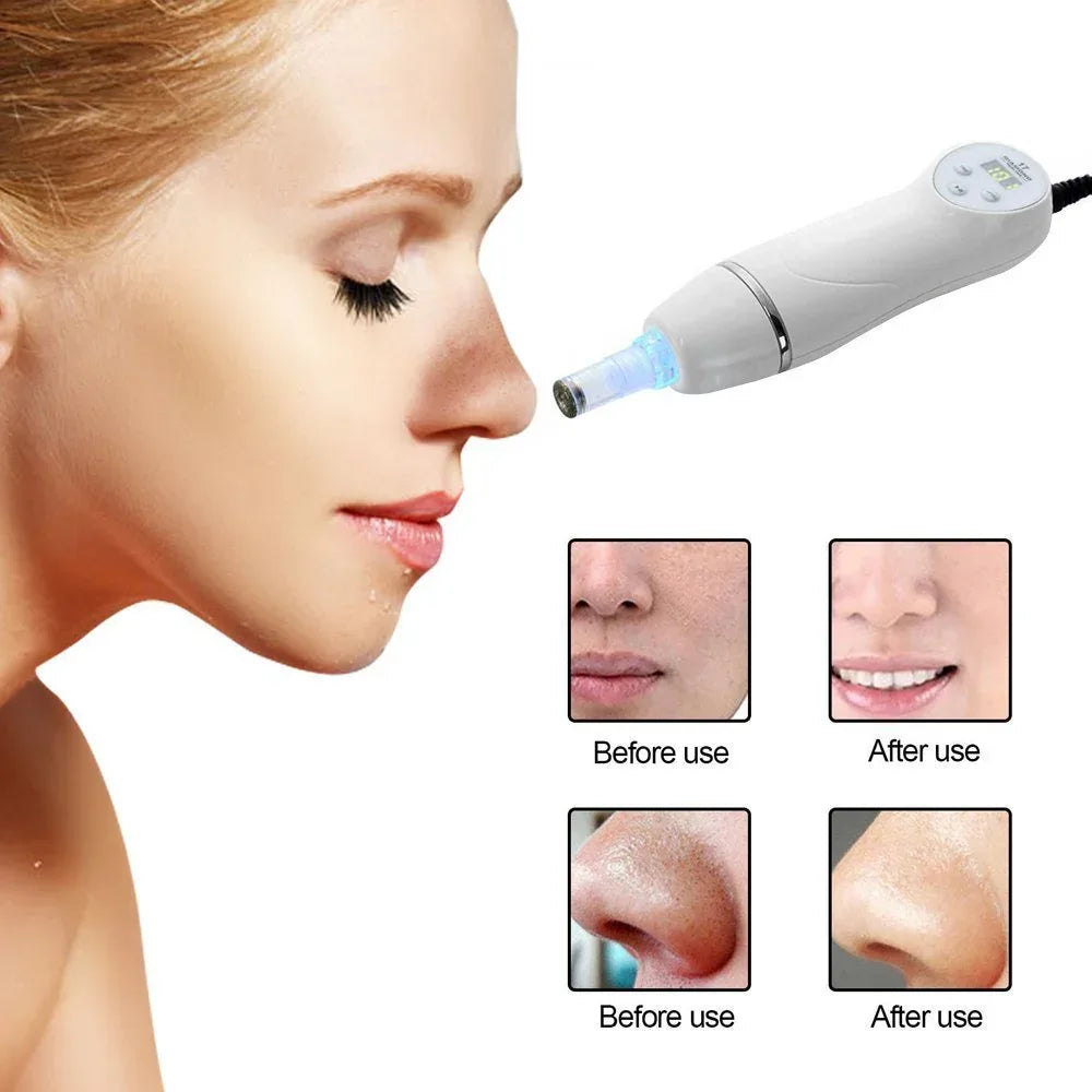 Electric Pore Cleaner Blackhead Remover